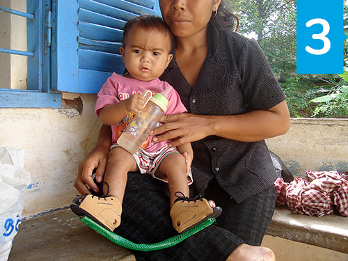 Un enfant suit un traitement simple et efficace pour soigner le pied bot
