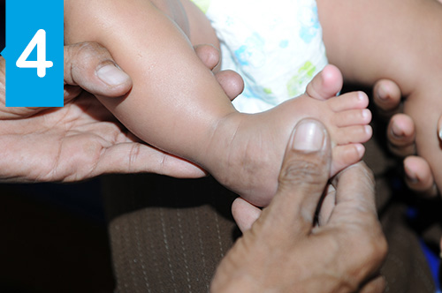 Des millions de nourrissons souffrent de la déformation du pied bot à la naissance.