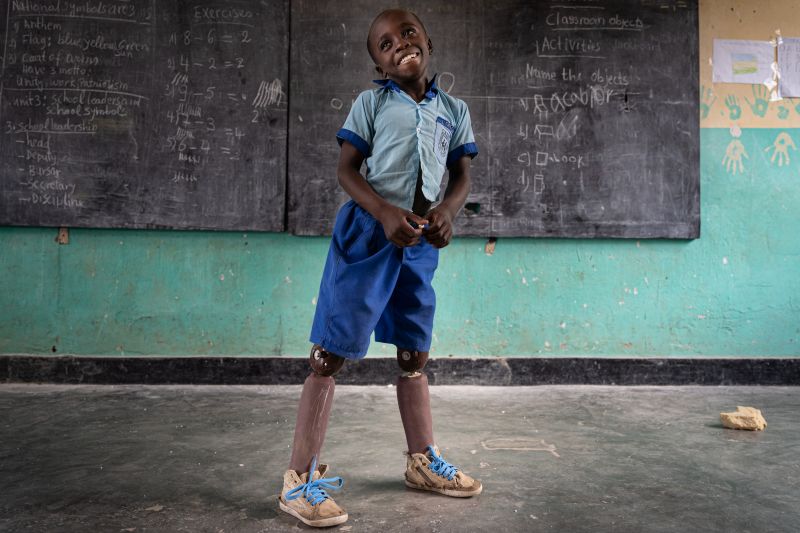 Un jeune enfant avec des prothèses de jambes devant un tableau dans une salle de classe